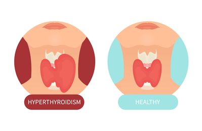 drawn diagram of a normal thyroid and a hyperthyroid
