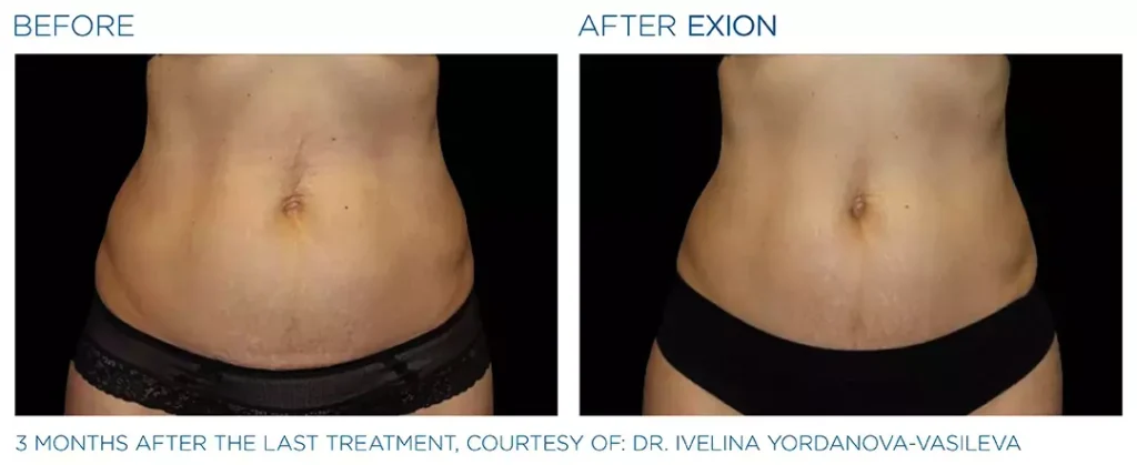 Exion 1024x419 1 - Mommy Makeover in Louisville, Kentucky