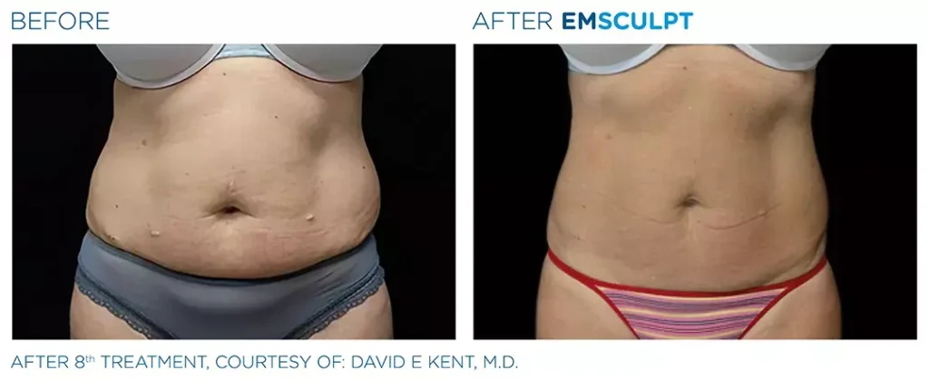 emsculpt 1024x419 1 - Mommy Makeover in Louisville, Kentucky