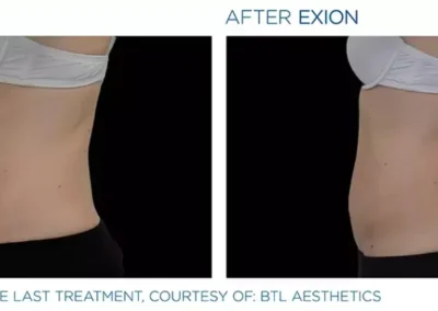 Before after Exion 1024x419 1 - Mommy Makeover in Louisville, Kentucky