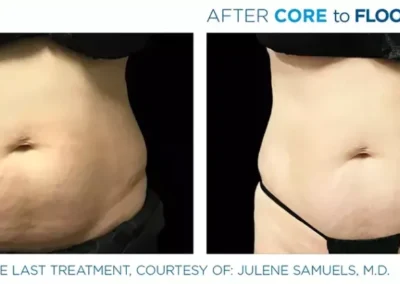 Core to floor 2 1024x419 1 - Mommy Makeover in Louisville, Kentucky