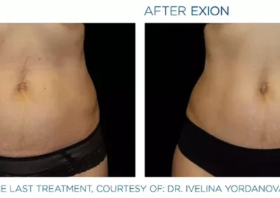 Exion 1024x419 1 - Mommy Makeover in Louisville, Kentucky