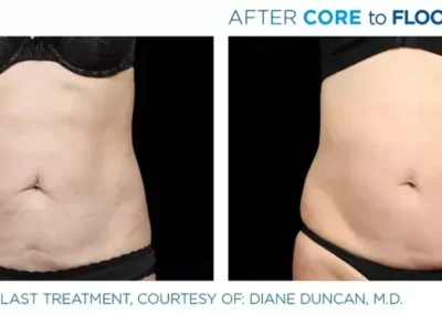 core to floor 1024x419 1 - Mommy Makeover in Louisville, Kentucky