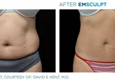 emsculpt 1024x419 1 - Mommy Makeover in Louisville, Kentucky