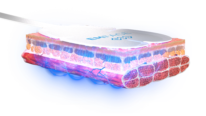 Emface PIC Applicator skin HIFES ENUS100 - EMFACE™ in Louisville, KY