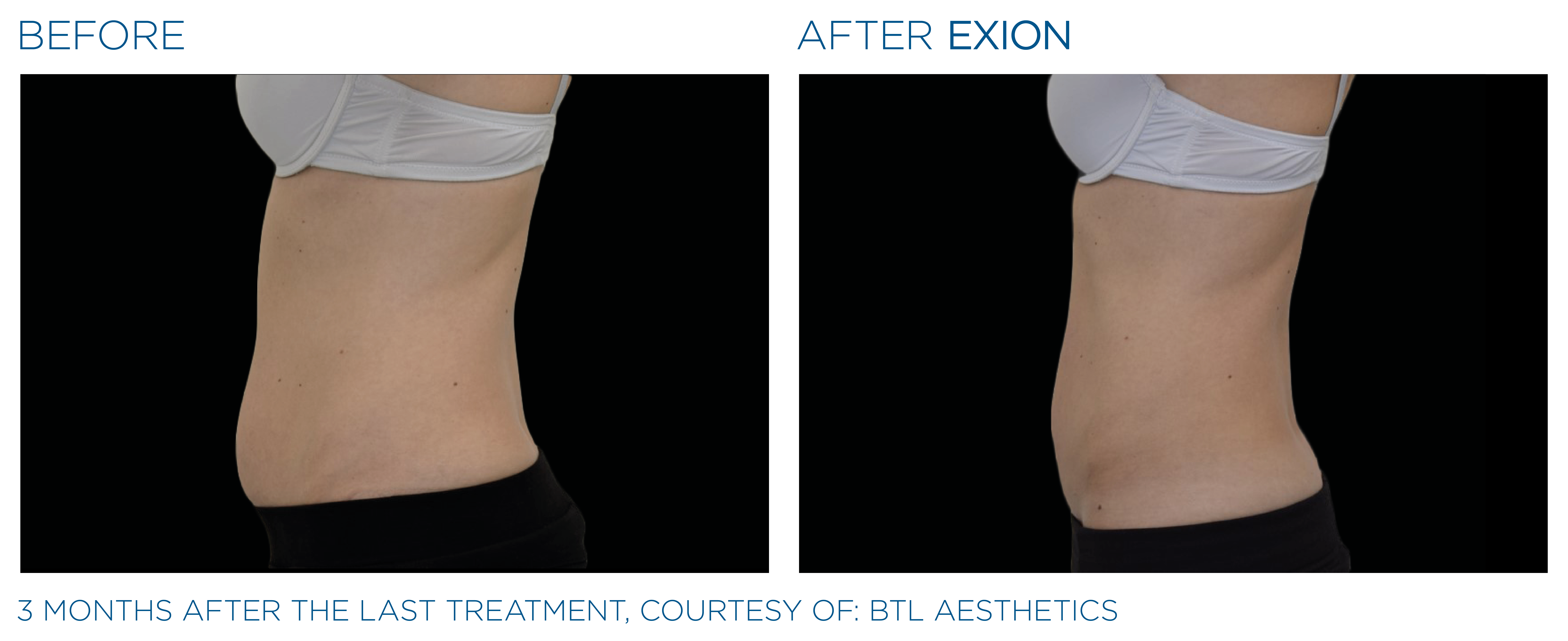 Exion PIC Ba card lateral abdomen female 034 Body ENUS100 - EXION™ in Louisville, KY